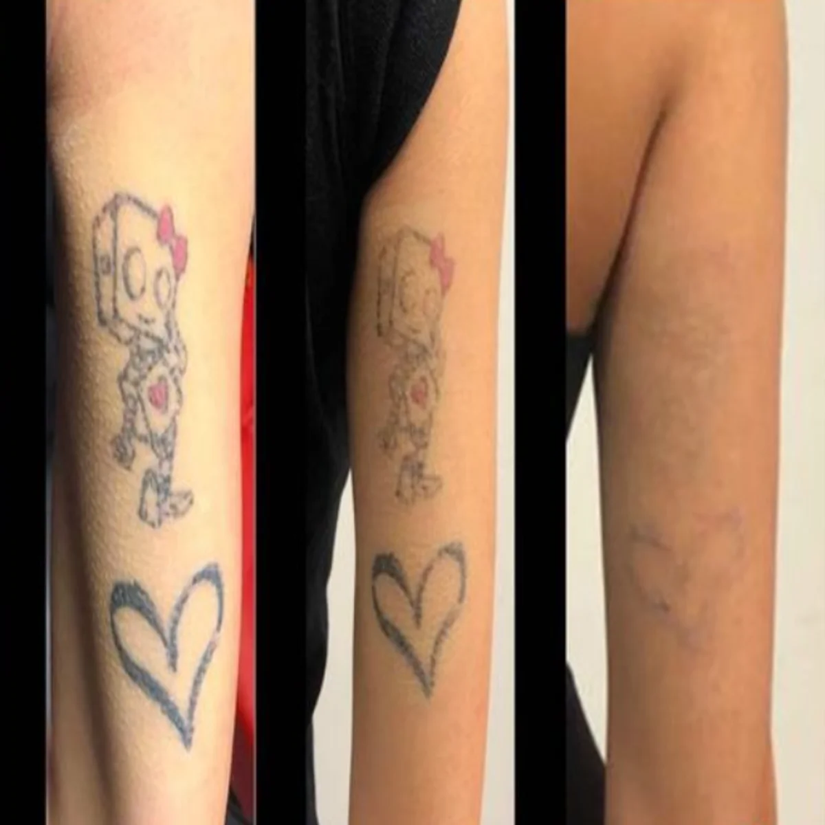 Tattoo Removal Melbourne